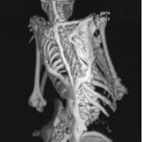 Stone Man√¢‚Ç¨‚Ñ¢s disease